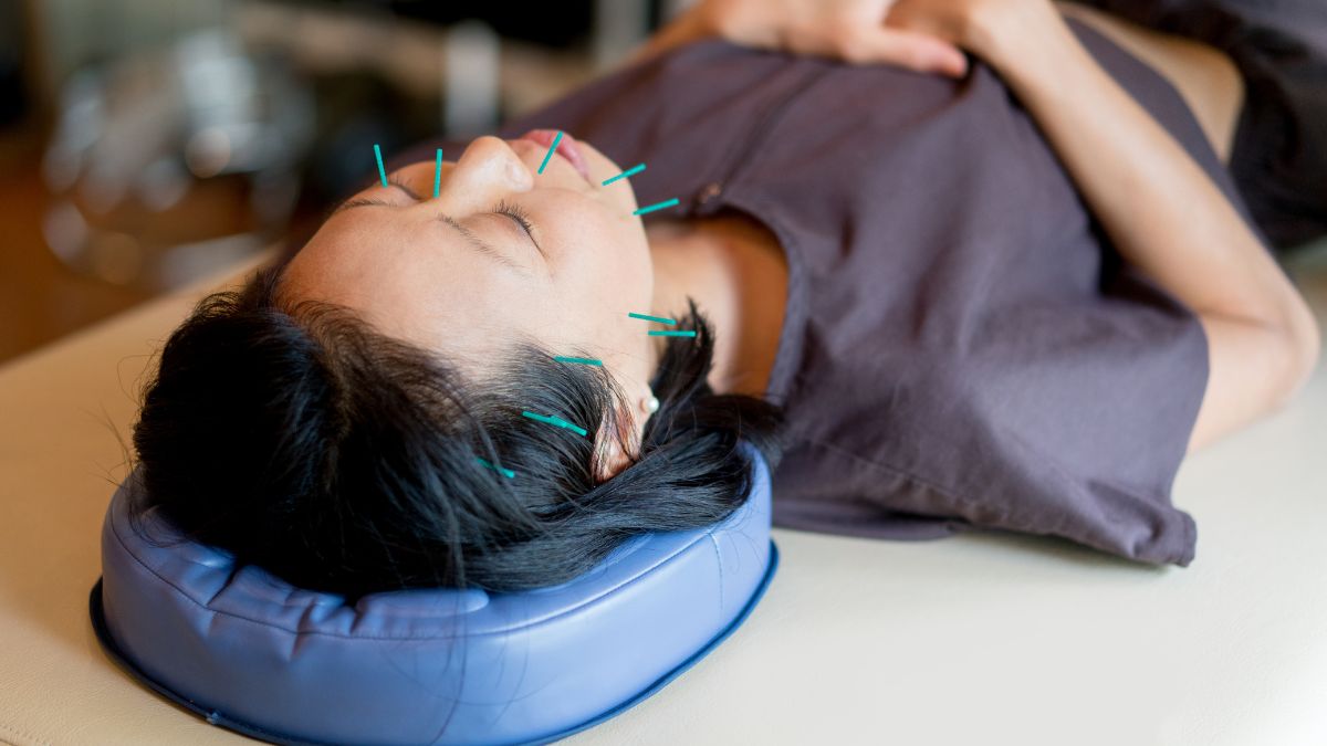 A photo of a woman with acupuncture needles on her face